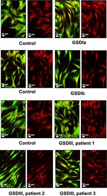 Metabolic Profiling in Human Fibroblasts Enables Subtype Clustering in Glycogen Storage Disease